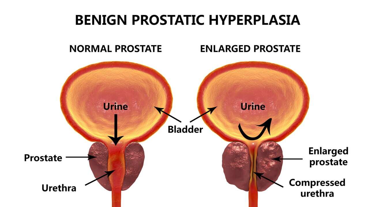 Benign prostatic hyperplasia