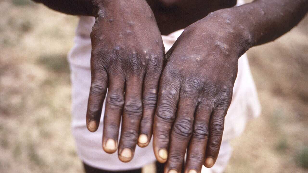 Hands infected with monkeypox virus