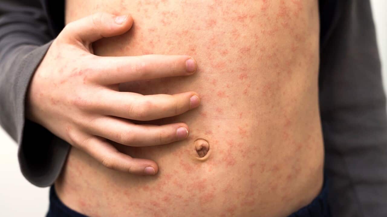 Sick child with red rash spots from measles.
