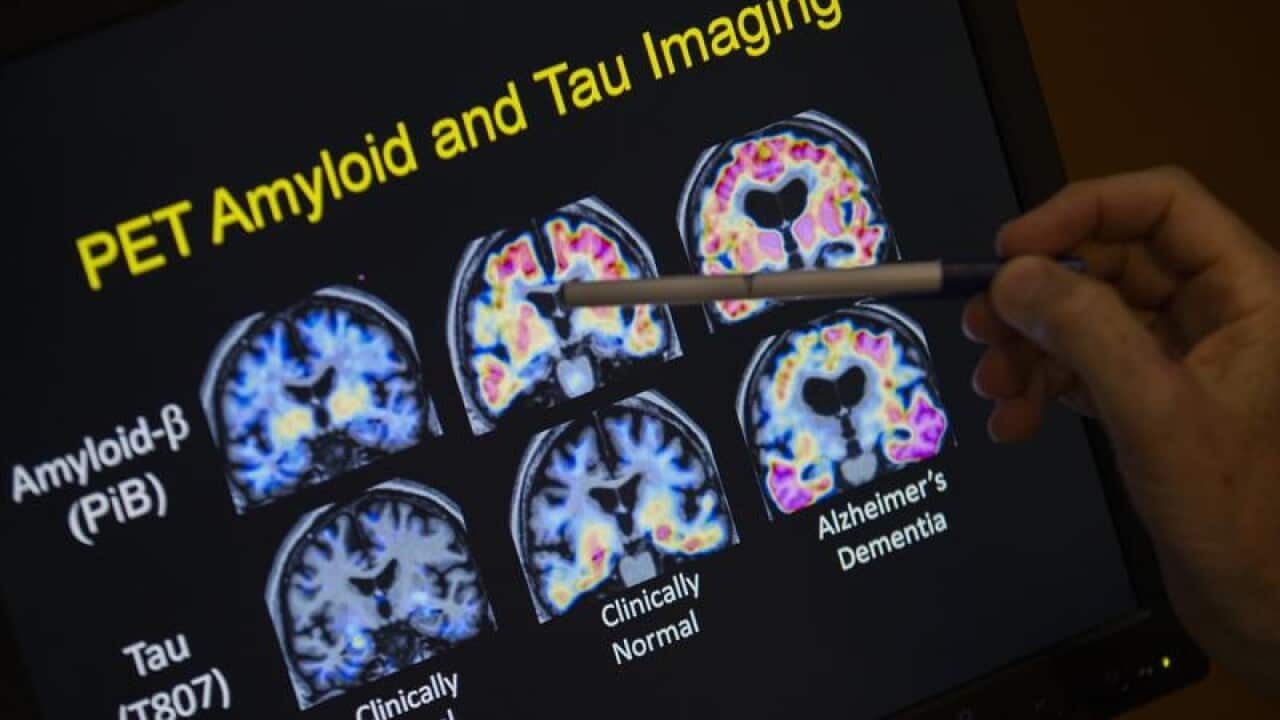 PET scan results that are part of a study on Alzheimer's disease