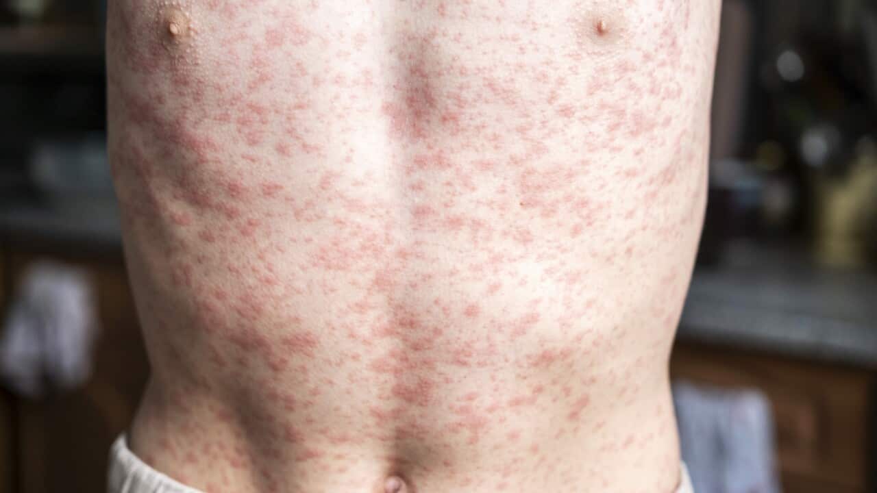 A person's body is covered in a rash, measles.