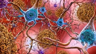 Illustration showing how tau and amyloid-β linked to dementia, form tangled sticky plaques in the brain (AP).jpg