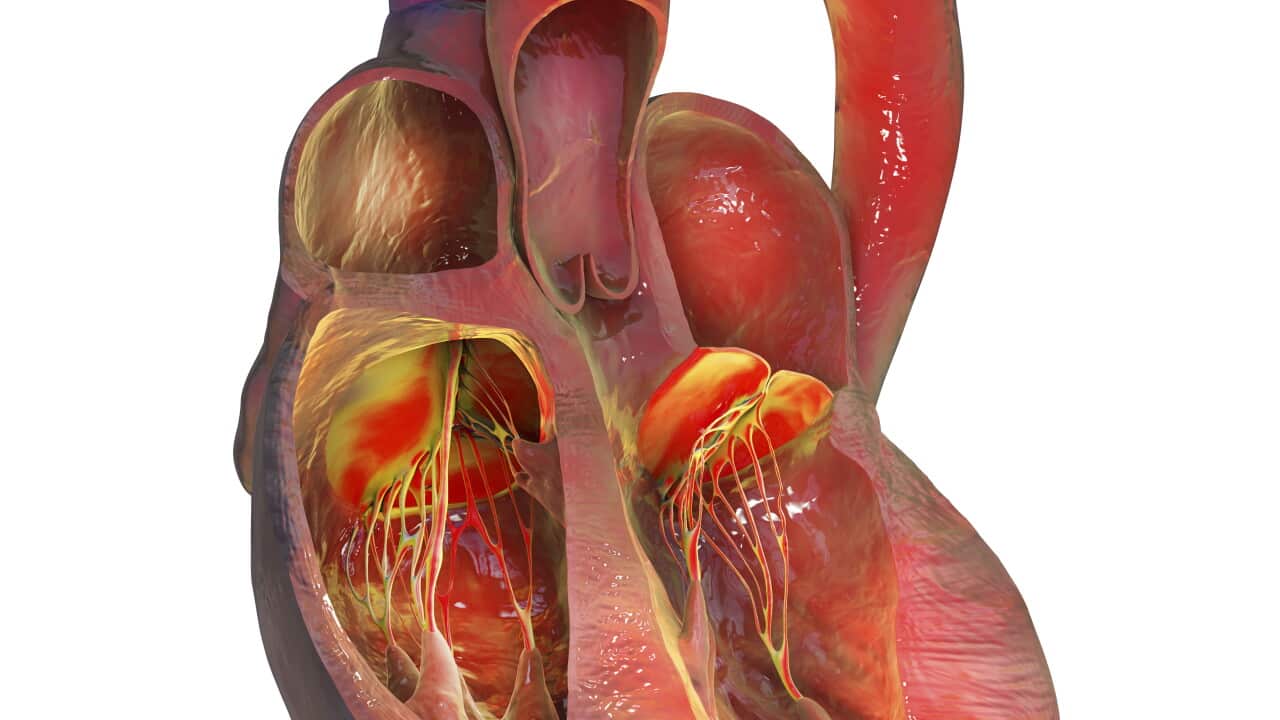 Left ventricular hypertrophy, illustration