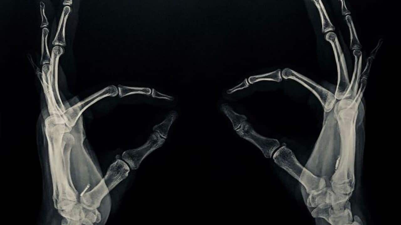 X-ray shows the chips in Kayla Heffernan's hands