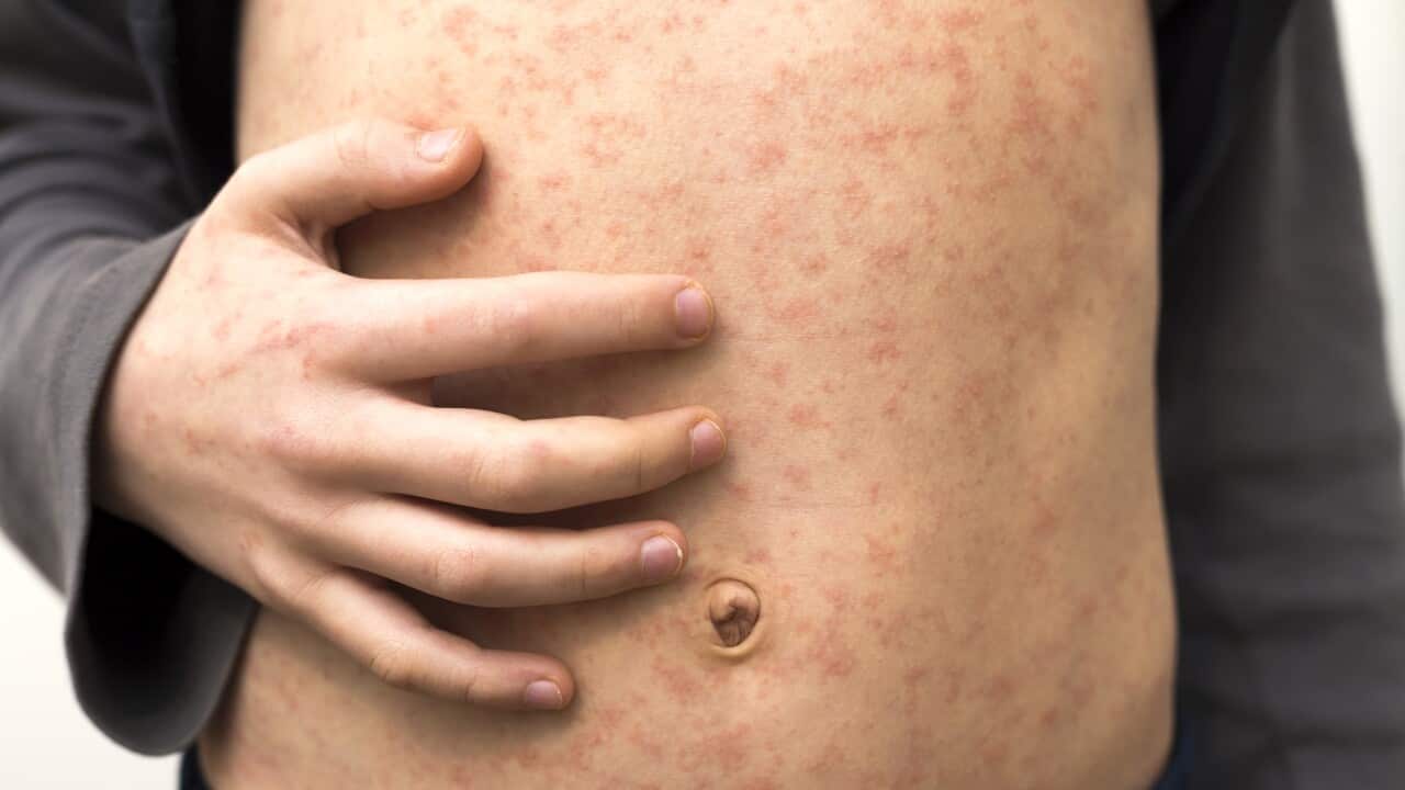 Sick child with red rash spots from measles.