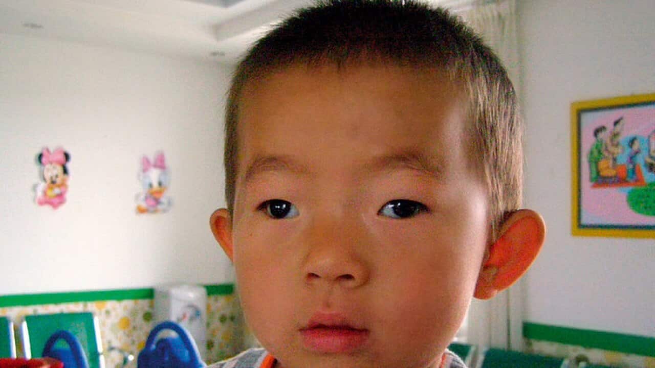 Child suffering from exotropia