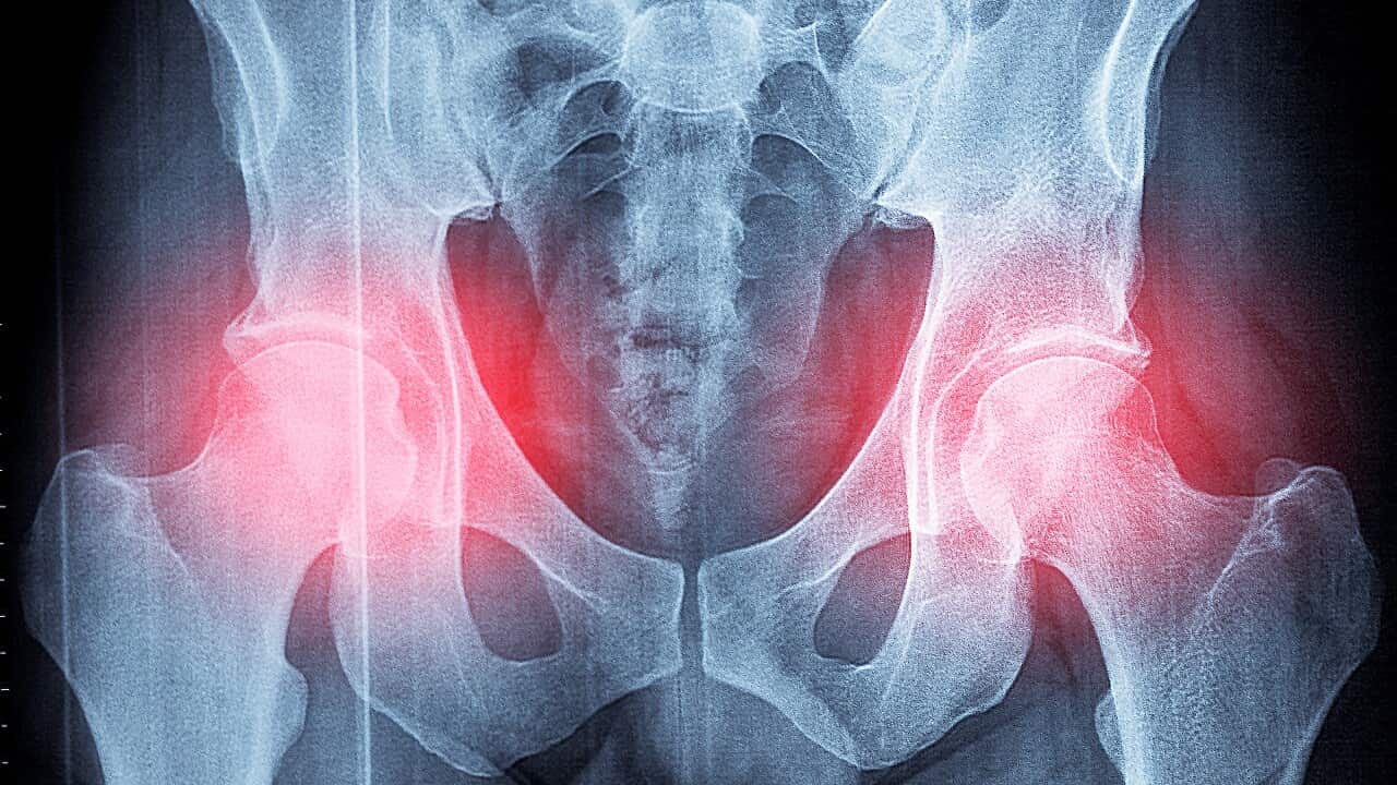 Pelvis x-ray 03
