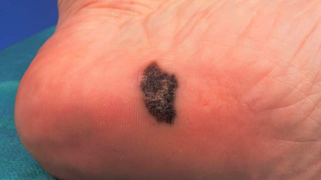 Acral lentiginous melanoma of the sole, level 1.