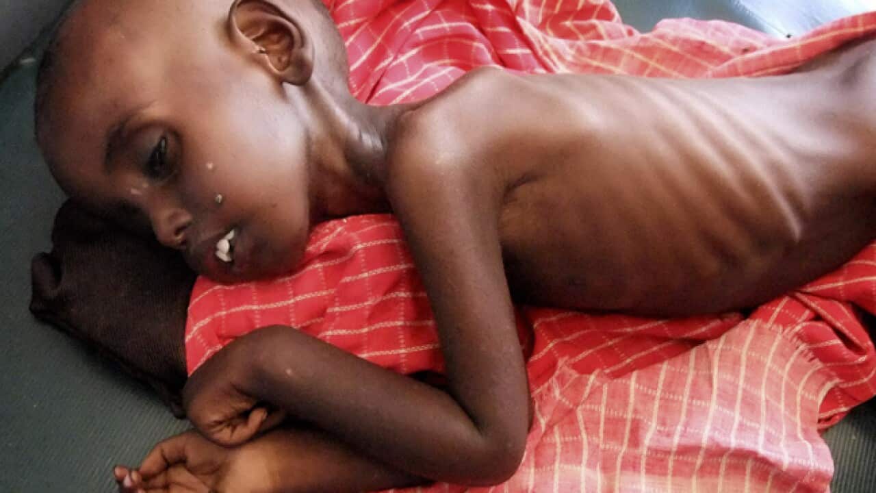 somalia_child_starving_b_110728_ap__2060418047