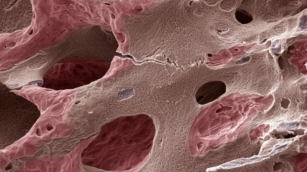 Scanning electron micrograph (SEM) of human bone, osteoporosis