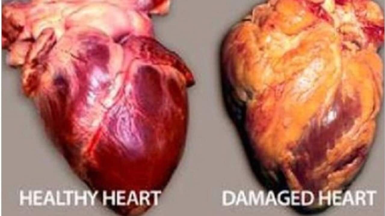 'Being overweight increases your risk of heart disease.'