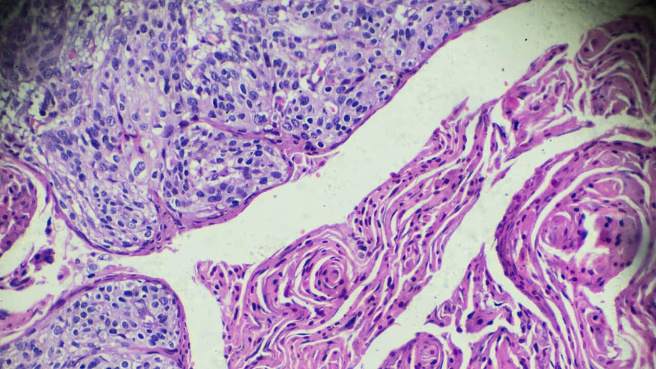Cervical Cancer (Squamous cell carcinoma) under light microscopy