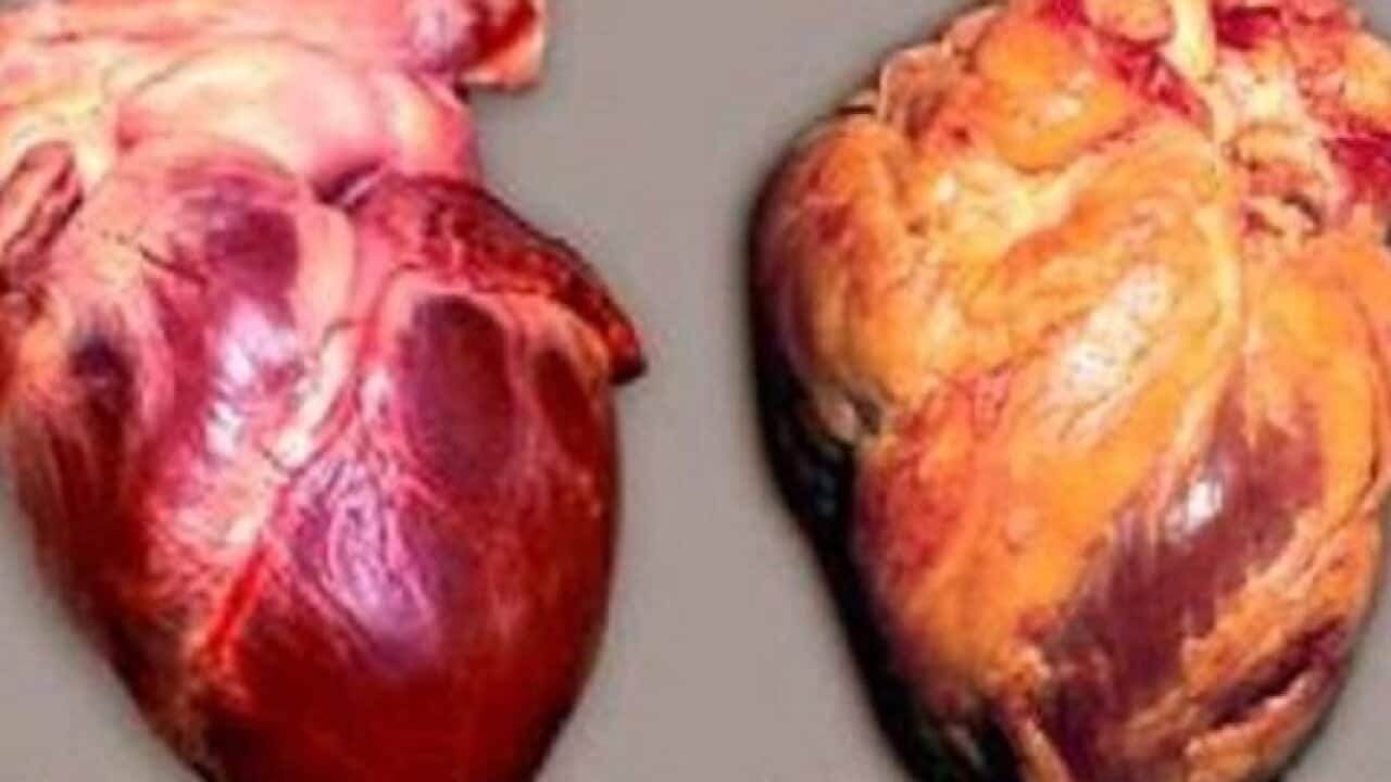 A healthy heart beside a damaged heart