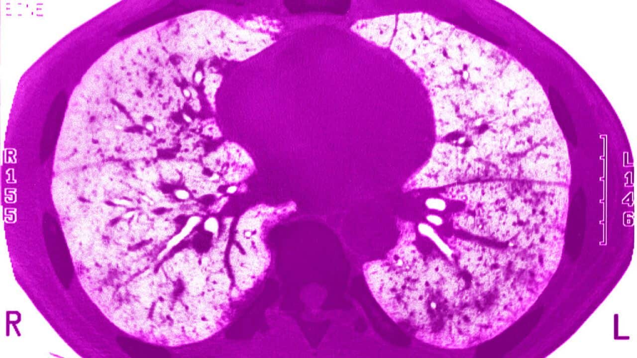 Explainer: what is TB and am I at risk of getting it in Australia?