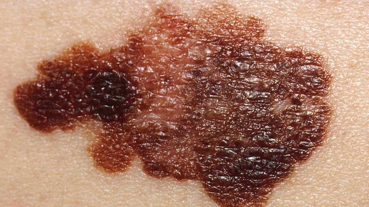 Melanoma, Skin Cancer