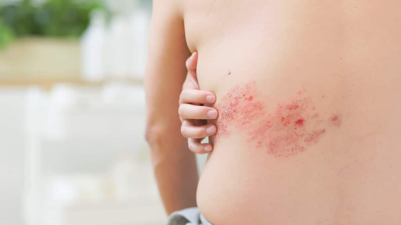 man has shingles disease