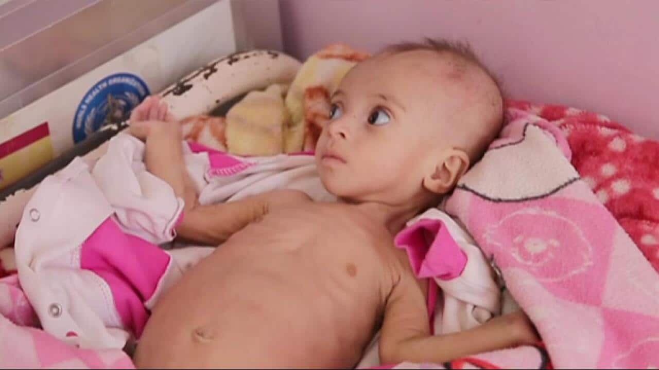 Approximately 1.3 million children under 5yrs old are suffering from acute malnutrition in Yemen.
