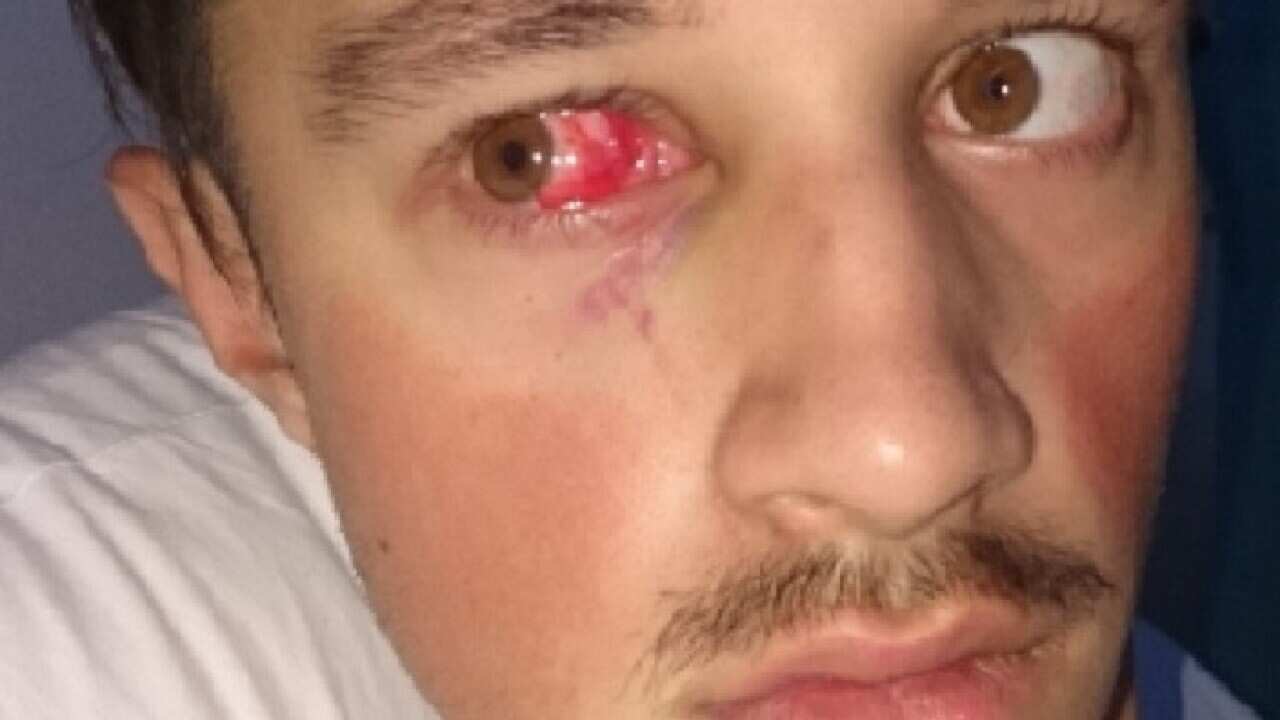 The victim of the February 17 robbery suffered instant blindness in his right eye.