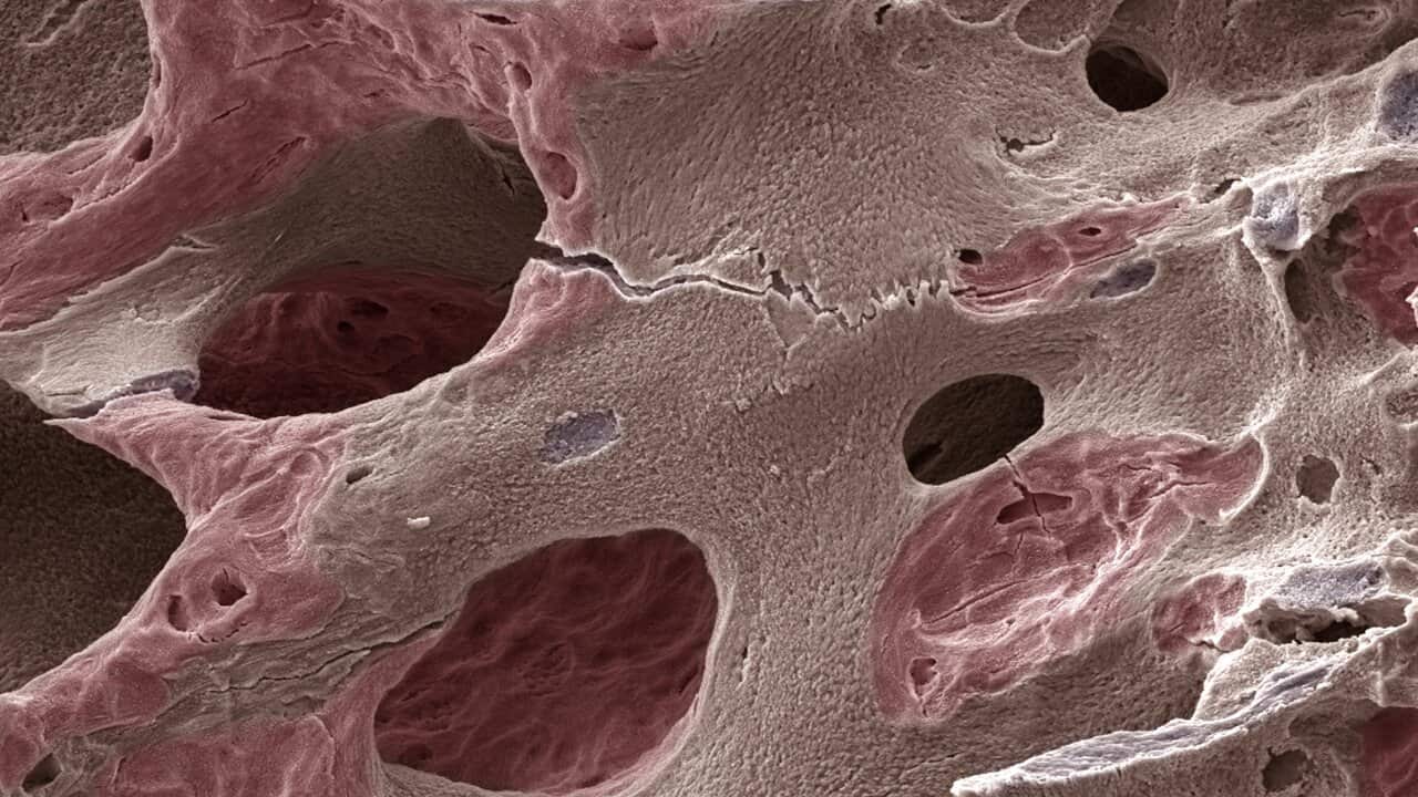 Scanning electron micrograph (SEM) of human bone, osteoporosis