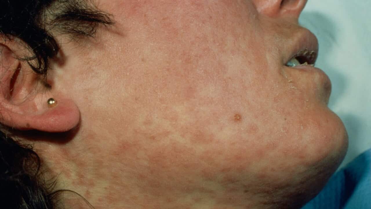 File image of a measles sufferer.