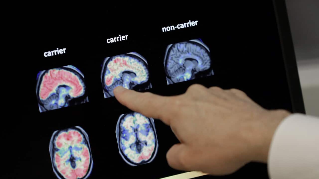 A PET brain scan from a US Alzheimer's Institute (AAP).