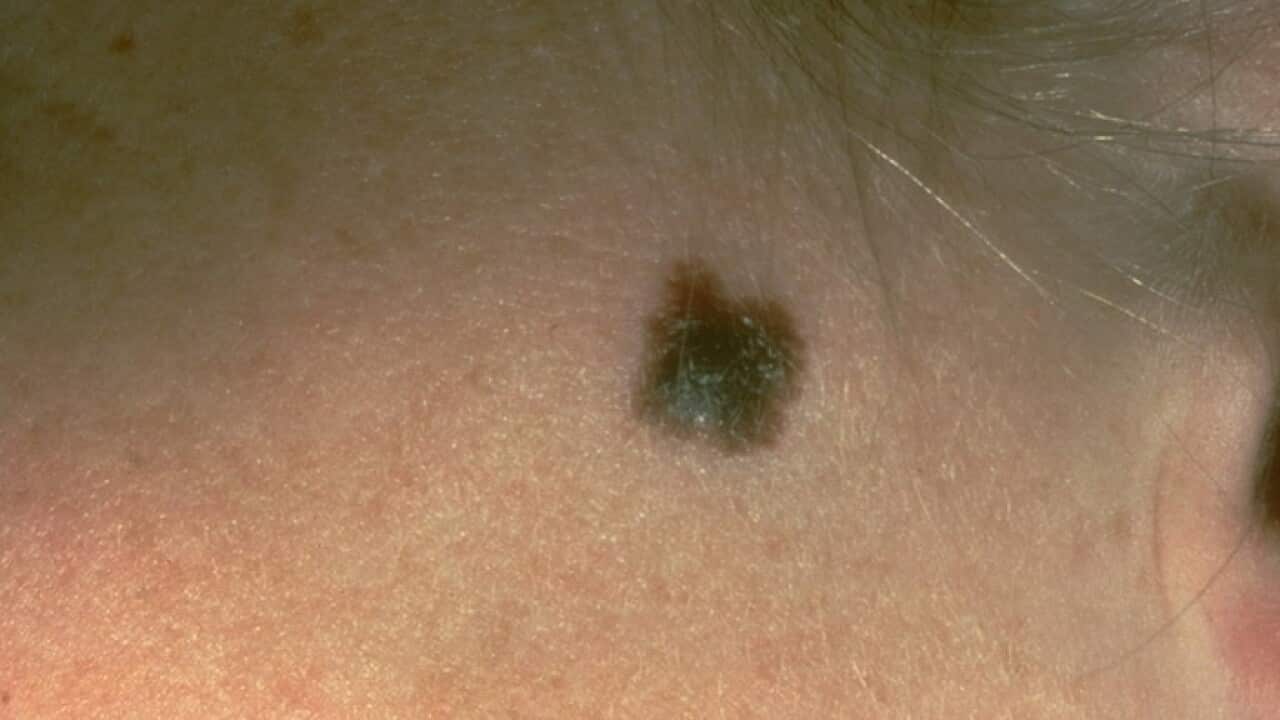 Asuspicious mole that was diagnosed as a melanoma