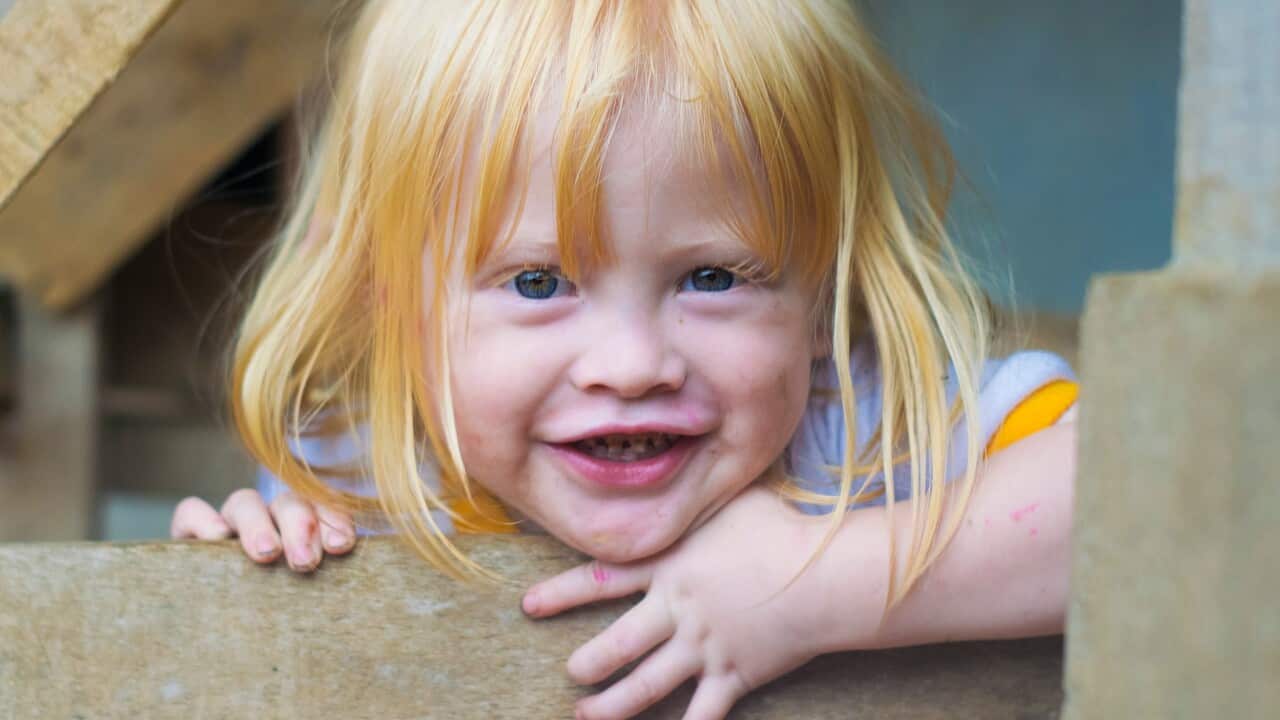 A child named Jajang, an albino person is seen at home in Ciburuy Village, Garut, West Java, on November 4, 2019. People with albino in Ciburuy Village can live normally with other communities.