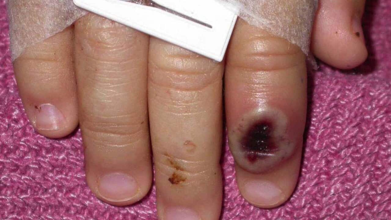 A skin lesion caused by the monkeypox virus