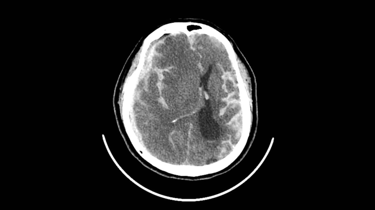 CT scan of a haemorrhagic stroke in a 65-year-old female patient (Getty).