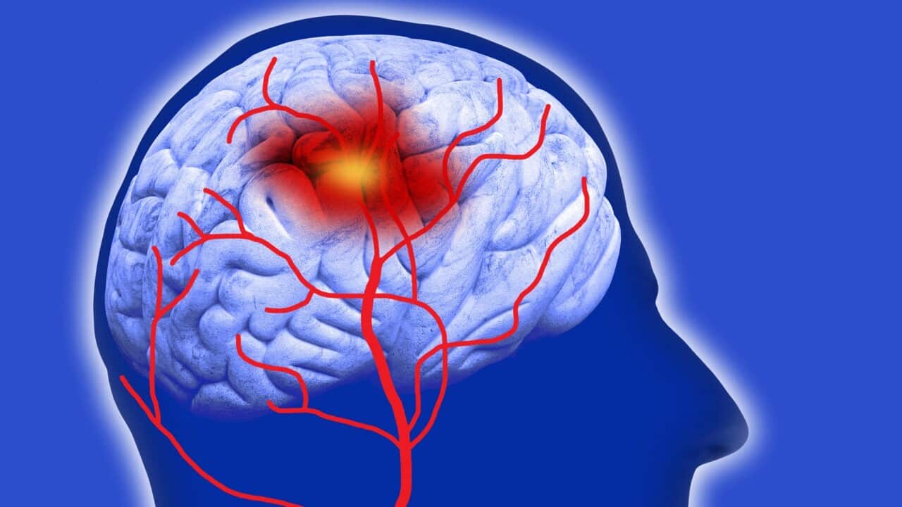 Human brain showing stroke