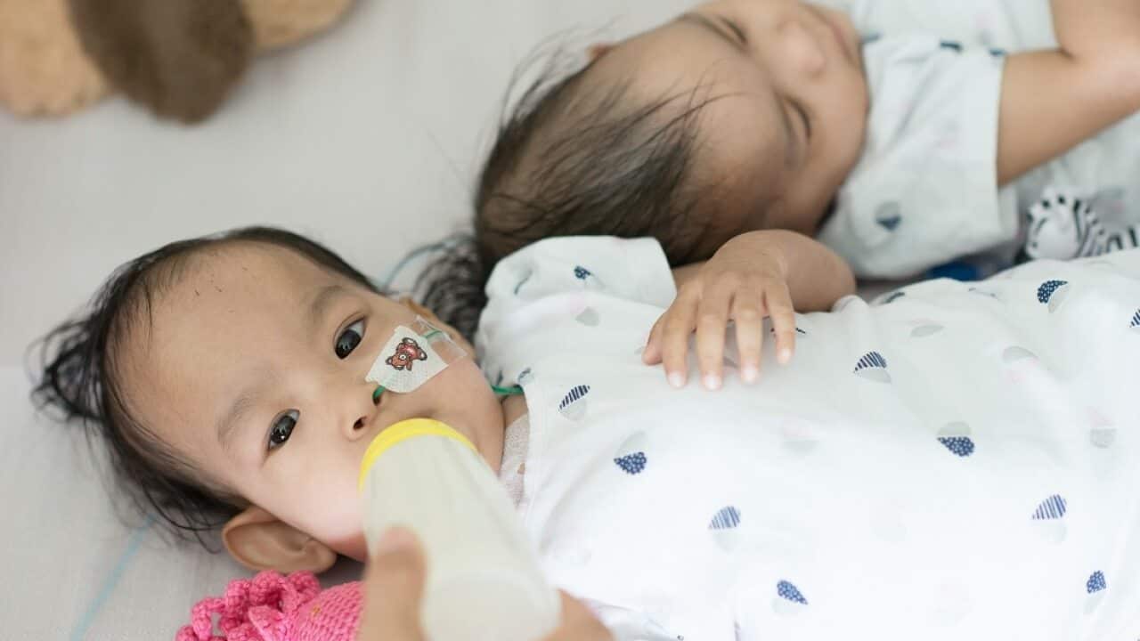 The twins are recovering well from their operation at the Royal Children's Hospital in Melbourne.