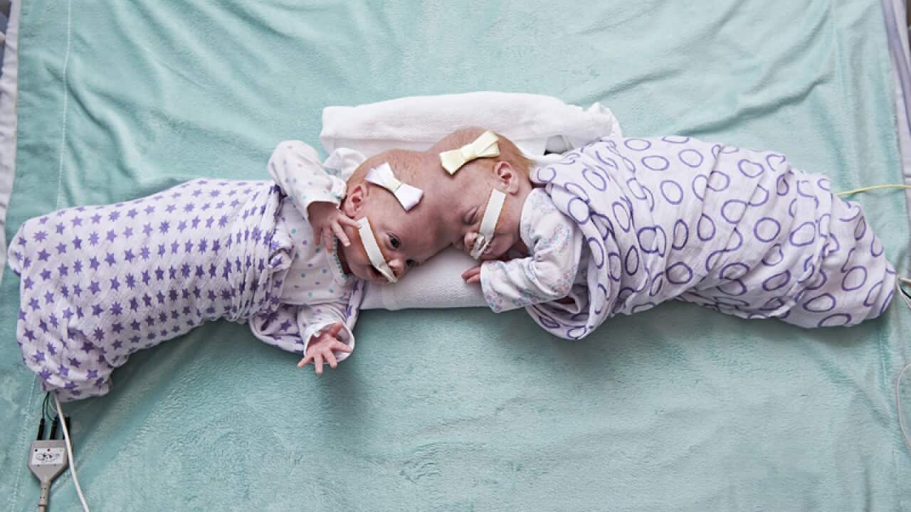 Conjoined twins Erin (L) and Abby Delaney