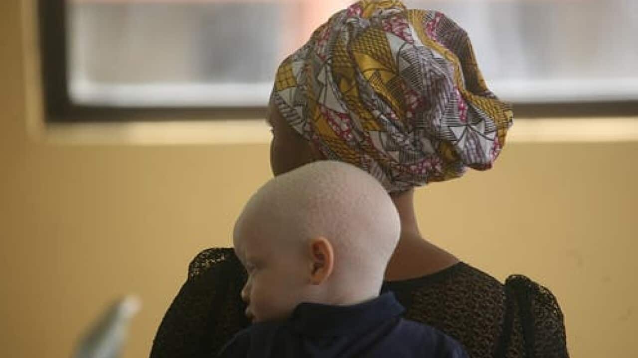 A mother hold her child who has albinism.