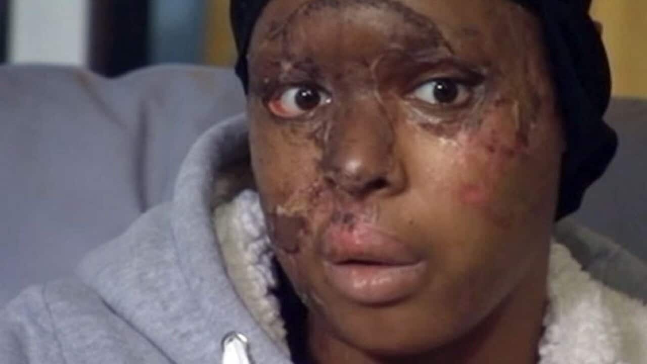 acid_victim_bbc_1689187674