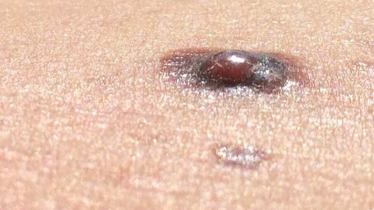 nodular melanoma