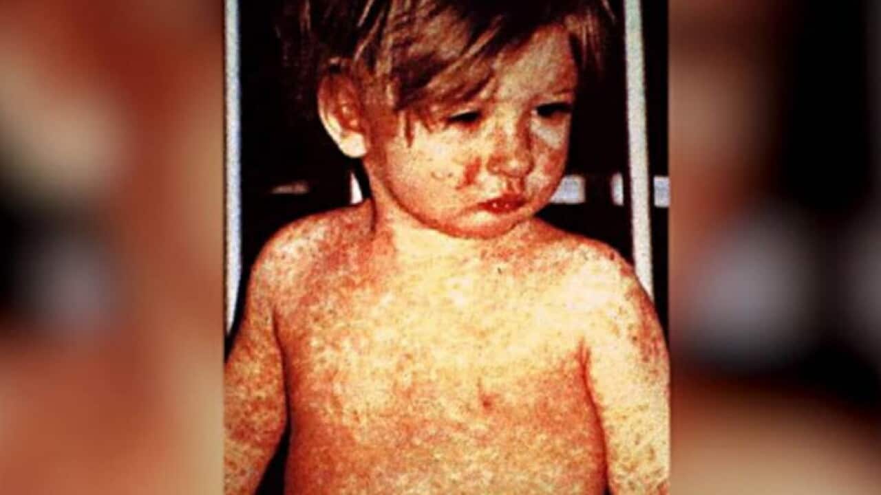 A case of measles.