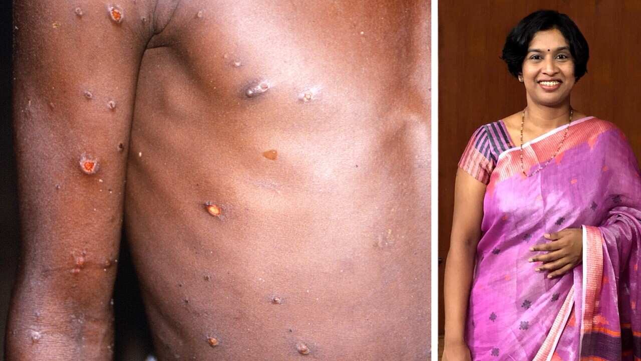 mpox virus