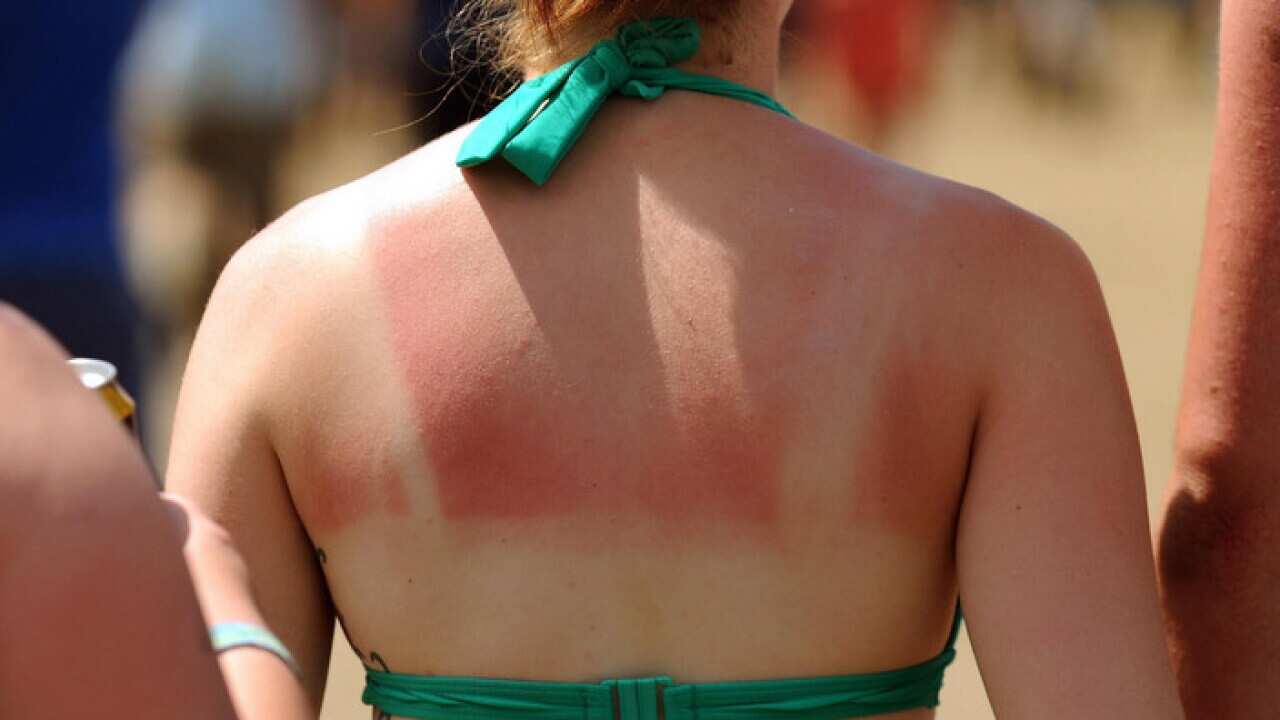 A woman with a sunburnt back