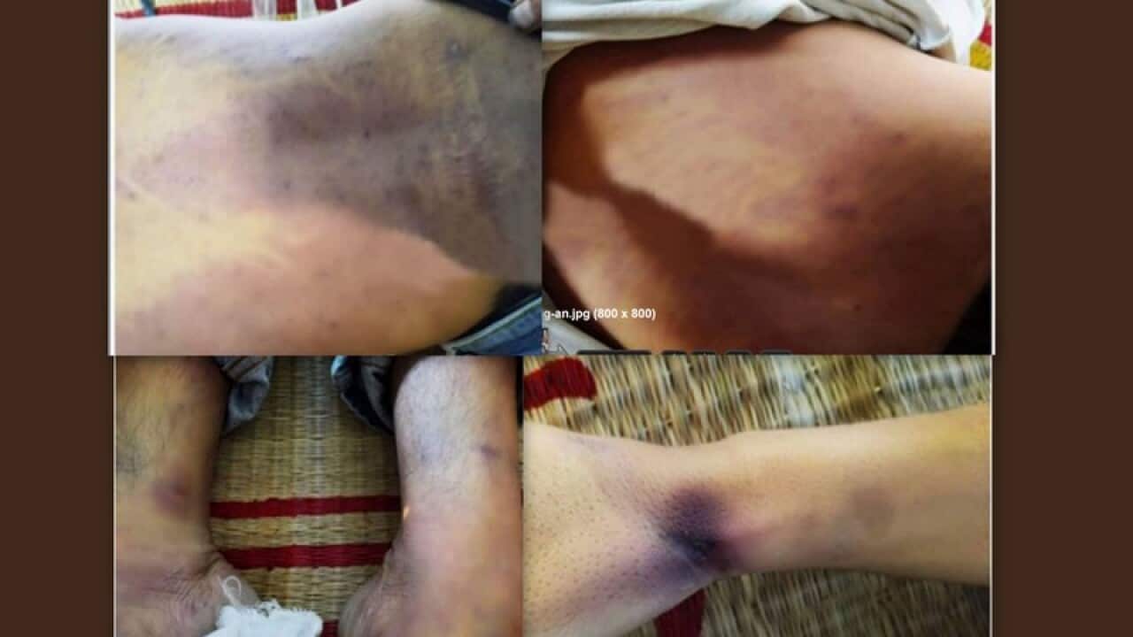 Vết bầm trên người anh Nguyễn Ngọc Nhân 29 tuổi ở Tân Phú Tân Đông Tiền Giang chêt khi bị bắt về đồn công an mà công an cho là chết do nhồi máu cơ tim.