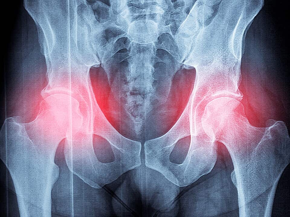 Pelvis x-ray 03