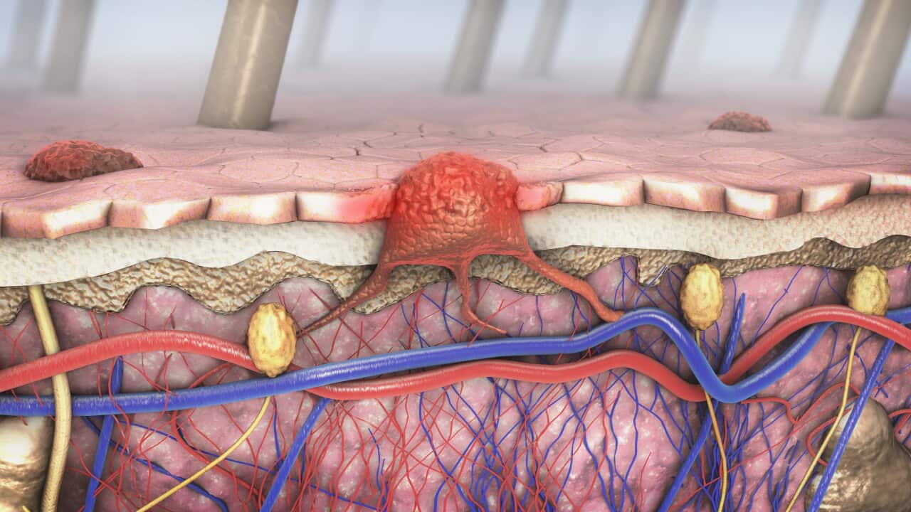 MELANOMA TREATMENT