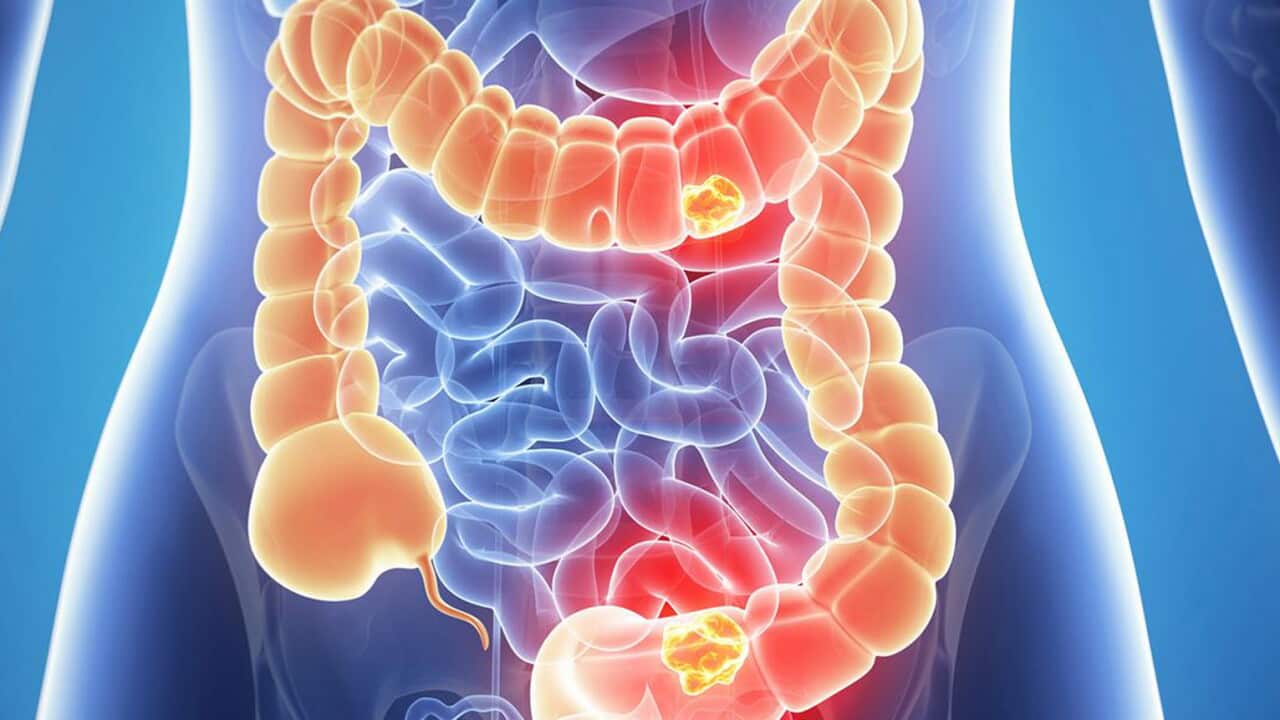 Bowel cancer study