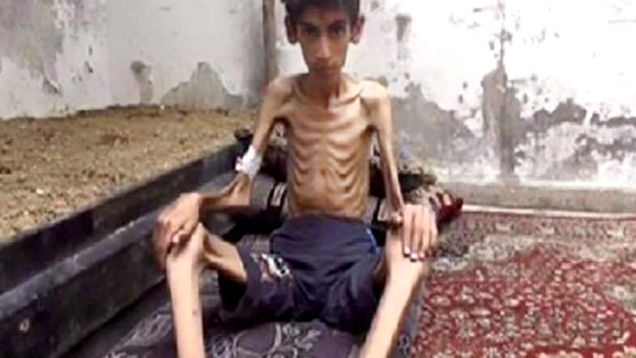 A starving child from Madaya, Syria