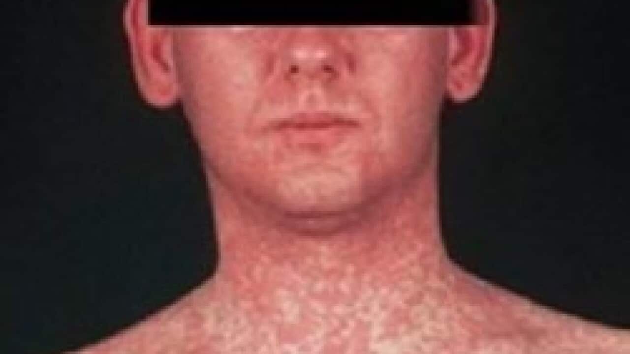 man-with-measles.jpg