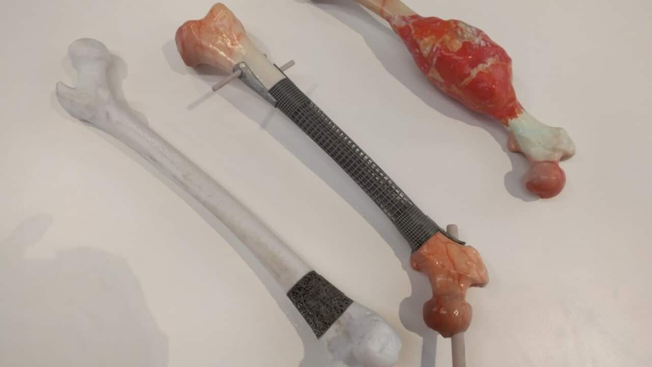 Bone with tumour; current implant; new 3D printed