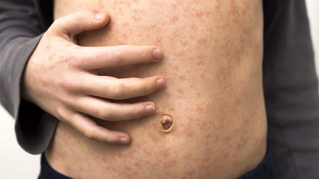 Sick child with red rash spots from measles.