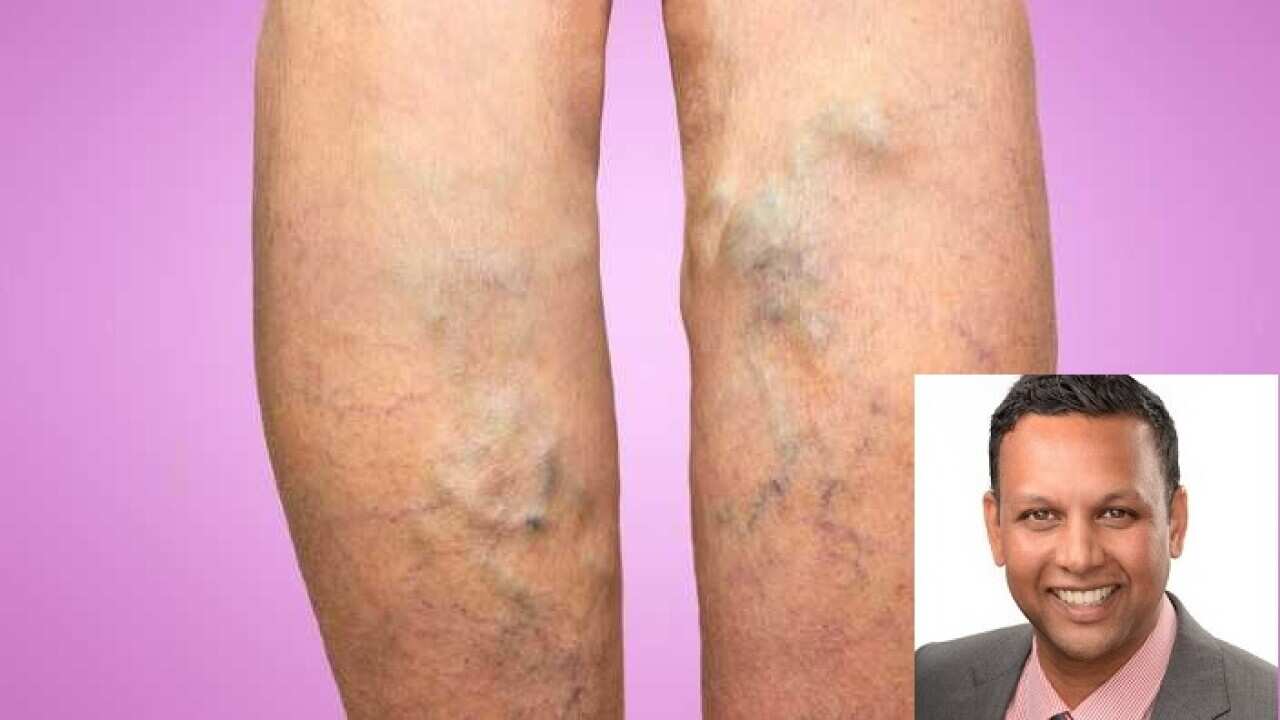 varicose vein-vena seal treatment
