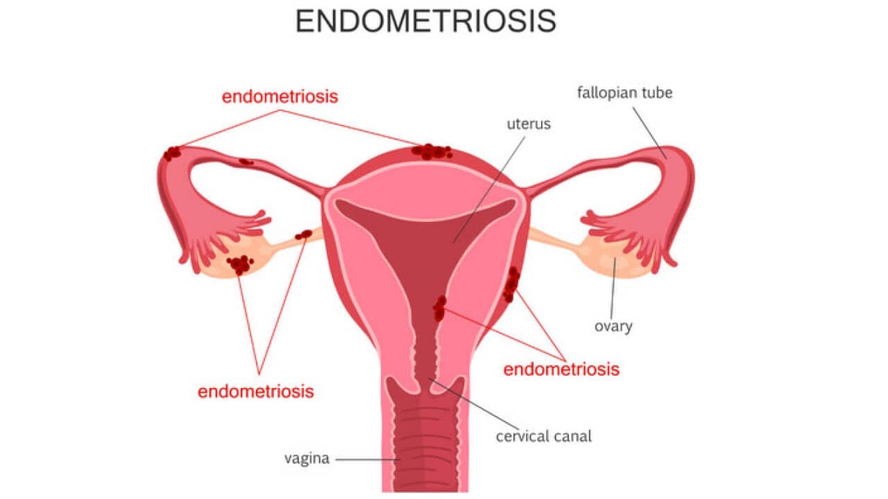 endometriosis