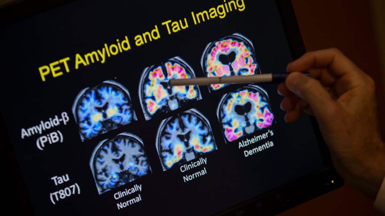 PET scan results that are part of a study on Alzheimer's disease at a hospital in Washington