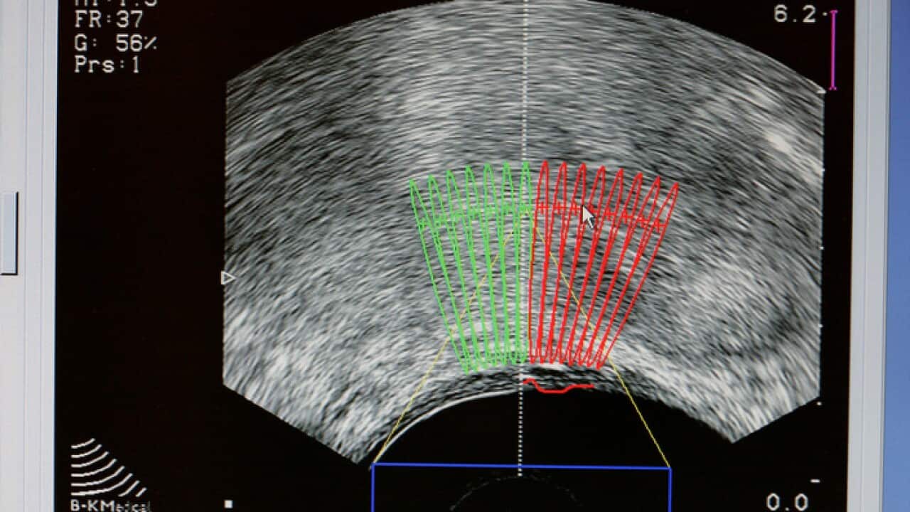 Prostate cancer ultrasound scan